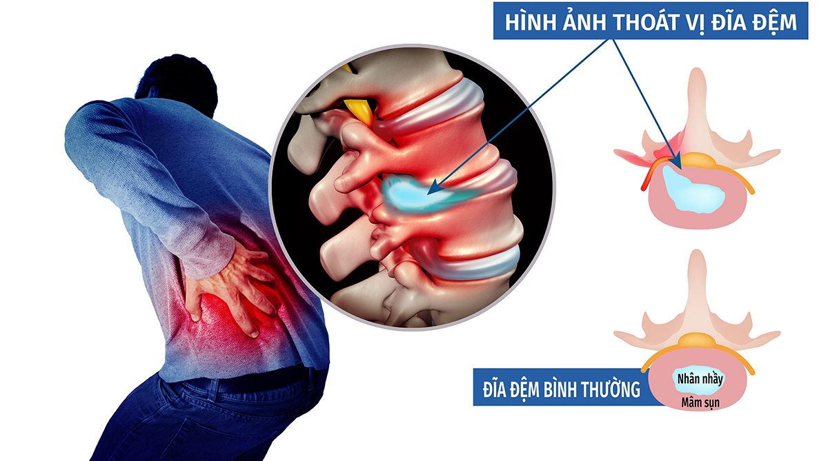 Tìm hiểu thông tin sơ lược về thoát vị đĩa đệm